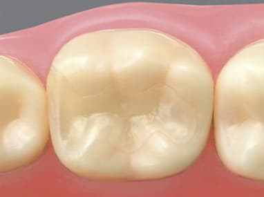 千葉市中央区の歯医者、医療法人社団 秀幸会 千葉スマイル歯科&矯正歯科でコンポジットレジン