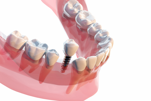 千葉市中央区の歯医者、医療法人社団 秀幸会 千葉スマイル歯科&矯正歯科のインプラント治療