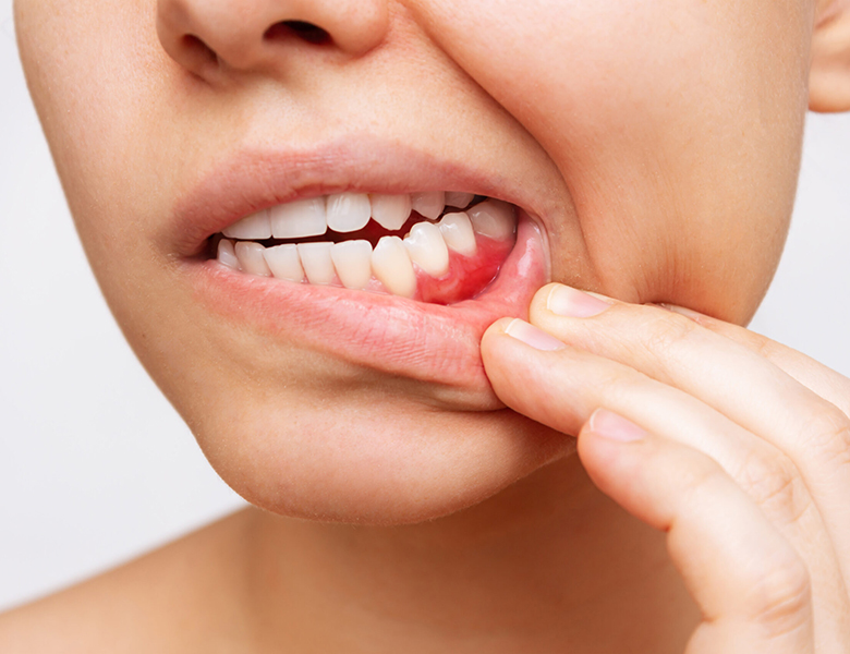 千葉市中央区の歯医者、医療法人社団 秀幸会 千葉スマイル歯科&矯正歯科の歯周病治療