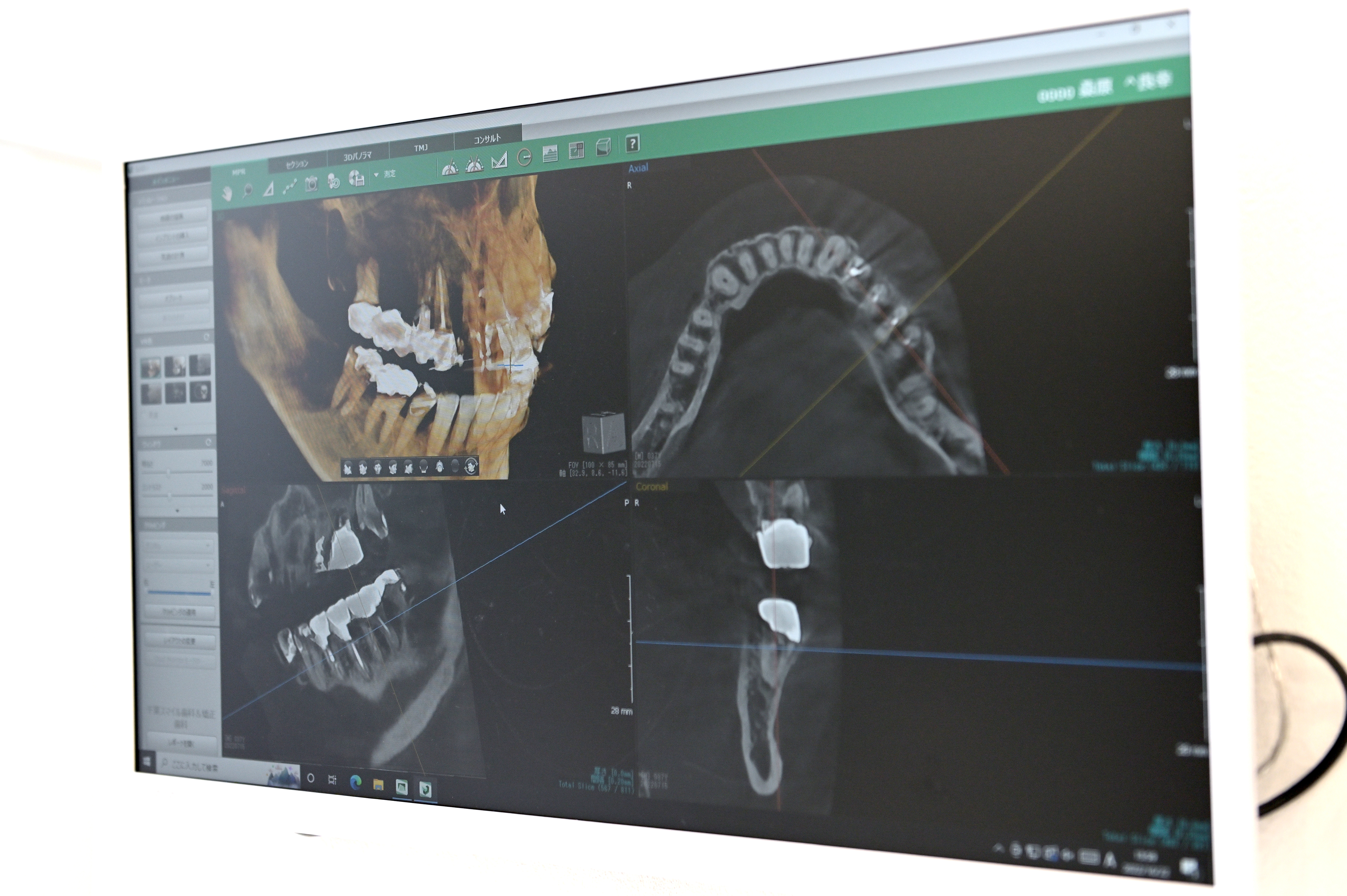 千葉市中央区の歯医者、医療法人社団 秀幸会 千葉スマイル歯科&矯正歯科で根管治療