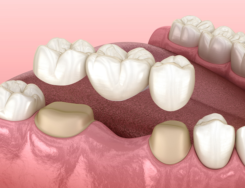 千葉市中央区の歯医者、医療法人社団 秀幸会 千葉スマイル歯科&矯正歯科のブリッジ