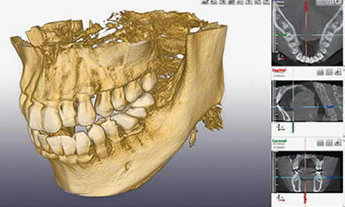 千葉市中央区の歯医者、医療法人社団 秀幸会 千葉スマイル歯科&矯正歯科のＣＴによる精密分析