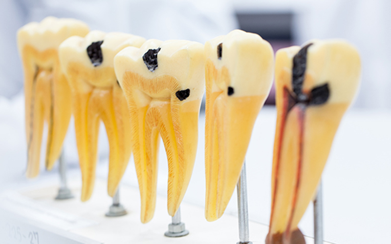 千葉市中央区の歯医者、千葉スマイル歯科&矯正歯科でむし歯治療