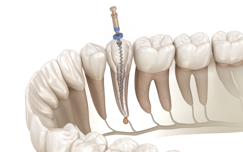 千葉市中央区の歯医者、千葉スマイル歯科&矯正歯科で根管治療