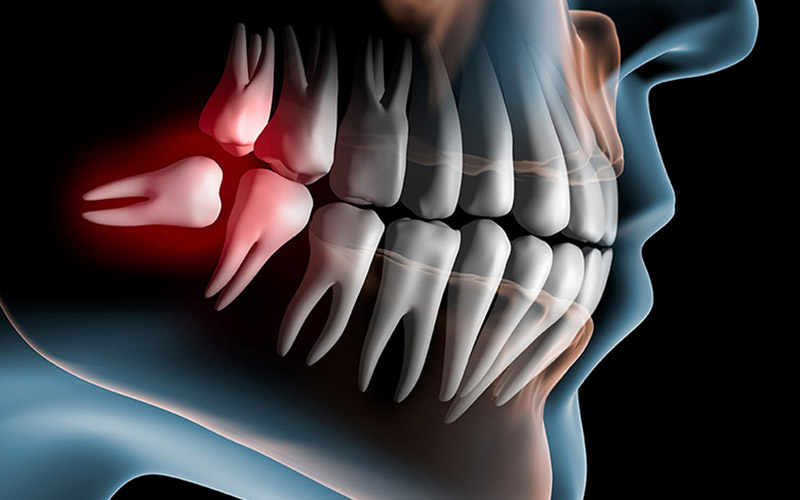 千葉市中央区の歯医者、千葉スマイル歯科&矯正歯科で親知らずの抜歯