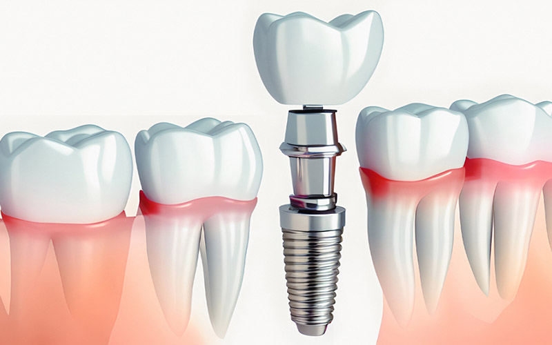 千葉市中央区の歯医者、千葉スマイル歯科&矯正歯科のインプラント