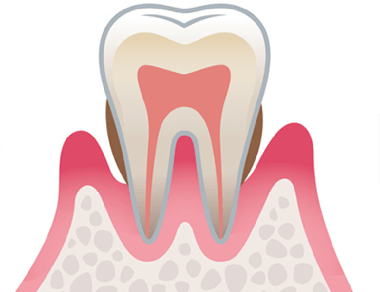 千葉市中央区の歯医者、医療法人社団 秀幸会 千葉スマイル歯科&矯正歯科の歯周病治療