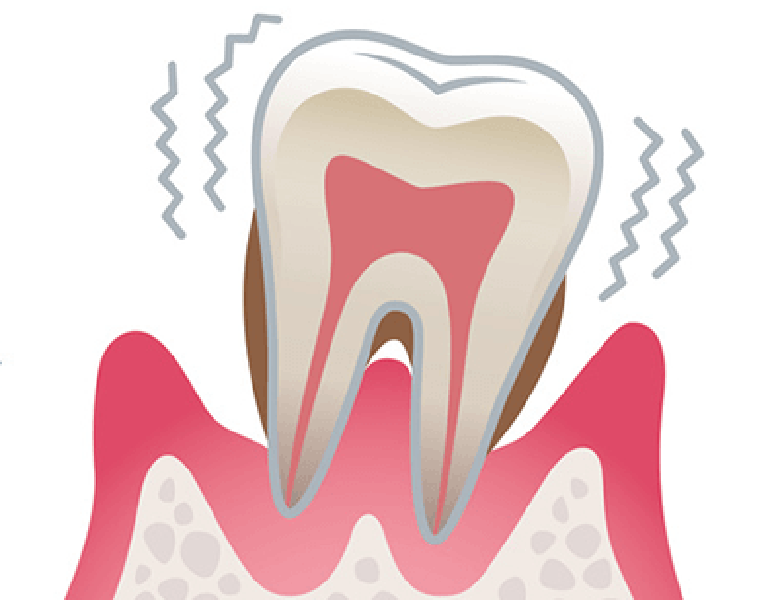 千葉市中央区の歯医者、医療法人社団 秀幸会 千葉スマイル歯科&矯正歯科の歯周病治療