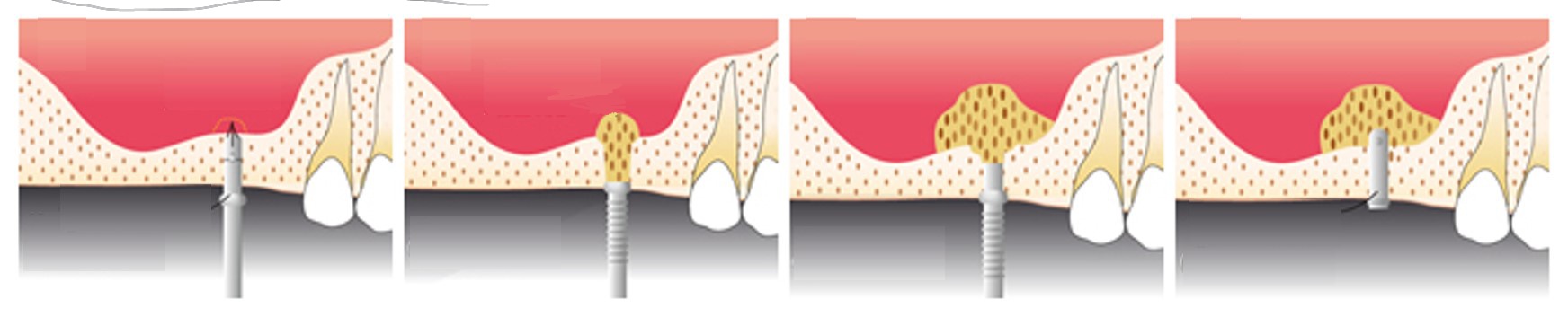 千葉市中央区の歯医者、医療法人社団 秀幸会 千葉スマイル歯科&矯正歯科のインプラント治療