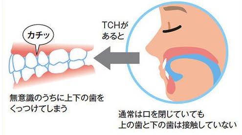 千葉市中央区の歯医者、医療法人社団 秀幸会 千葉スマイル歯科&矯正歯科のの歯列接触癖対策