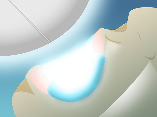 千葉市中央区の歯医者、医療法人社団 秀幸会 千葉スマイル歯科&矯正歯科のホワイトニング